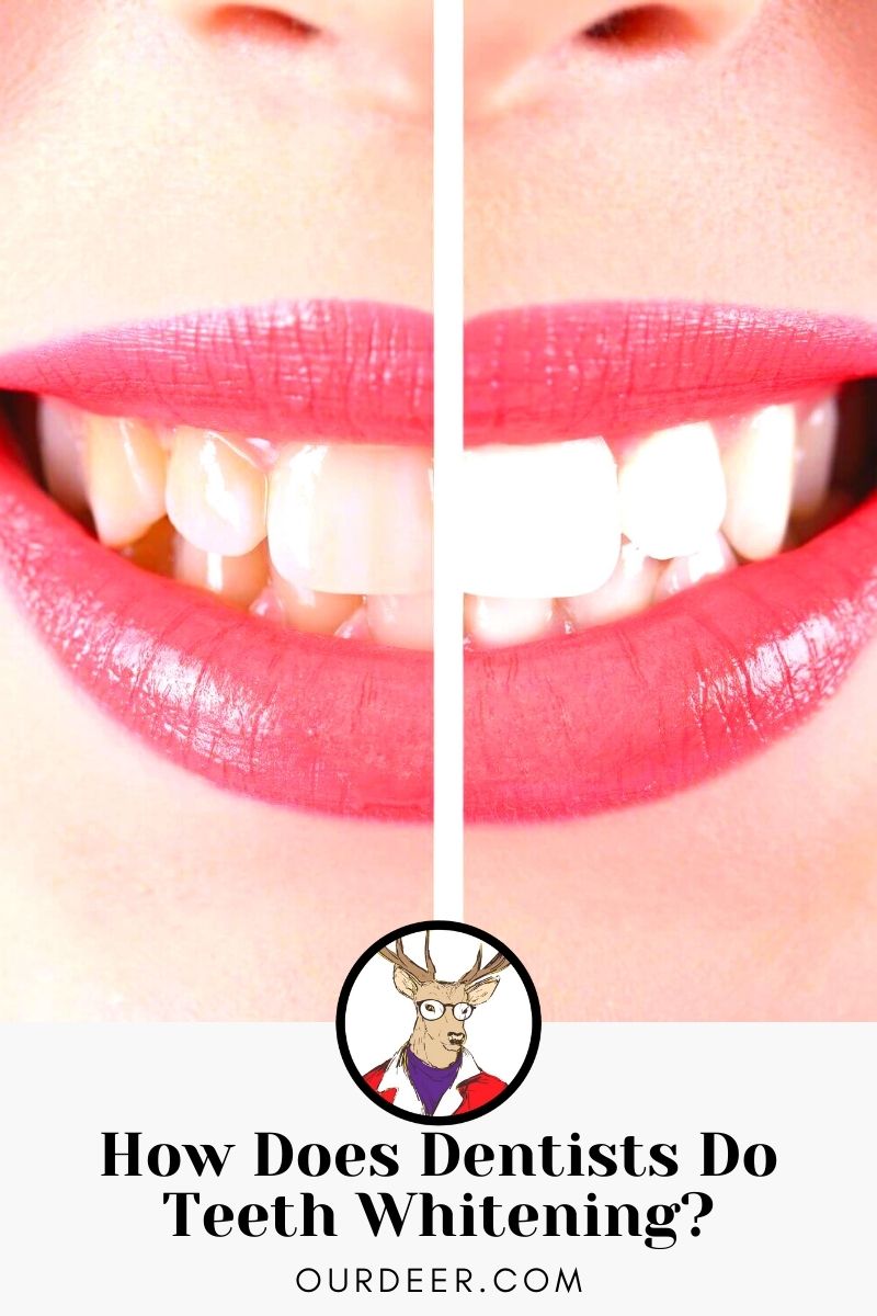 How Does Dentists Do Teeth Whitening? Our Deer