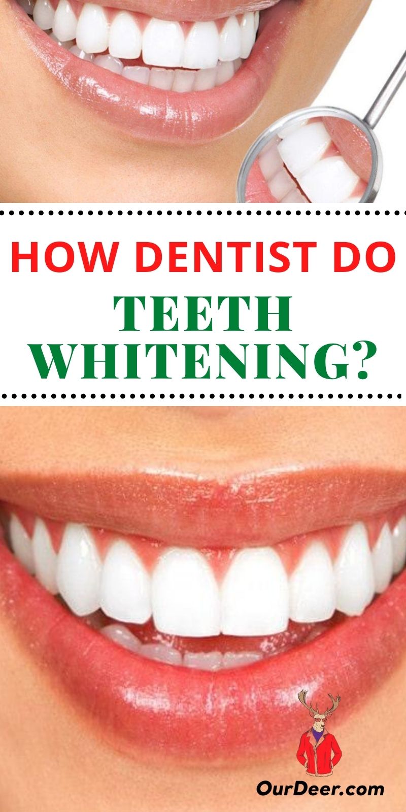 Teeth Whitening