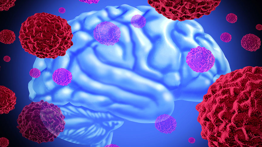 Brain Cancer Fast Facts