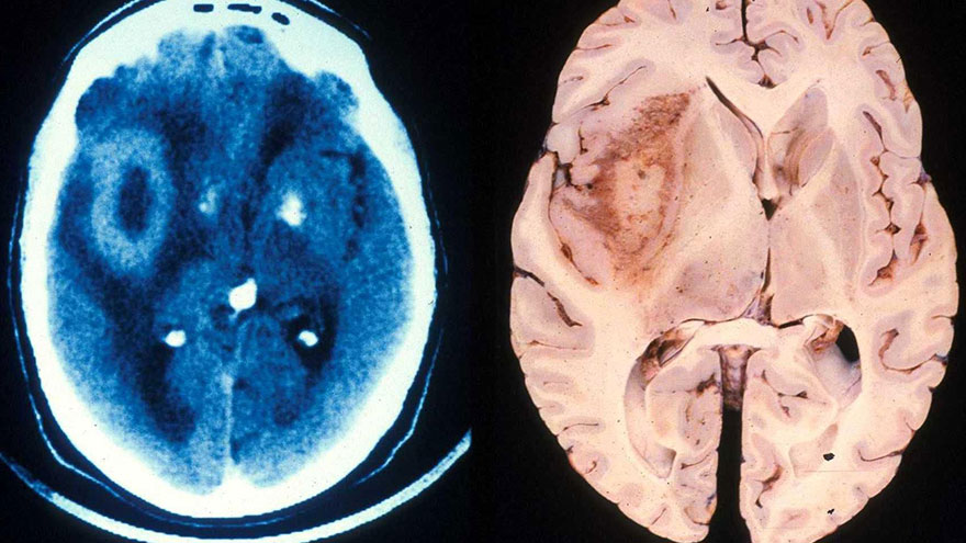 Glioblastoma Brain Cancer