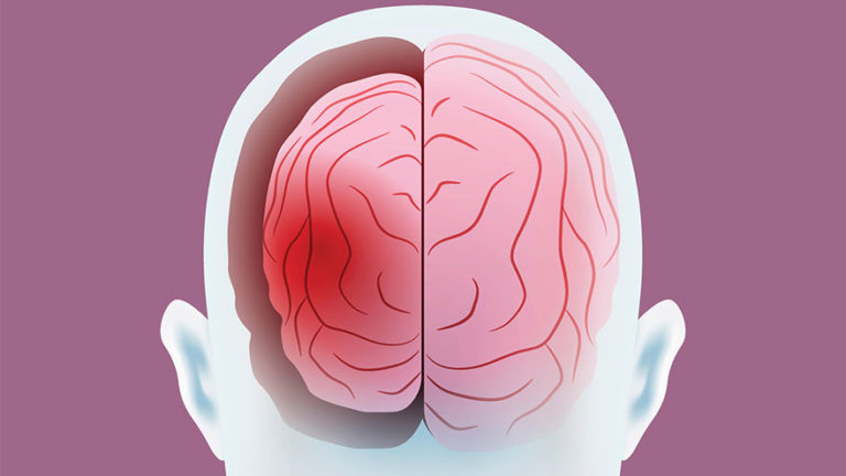 Lesion On Temporal Lobe Effects Our Deer