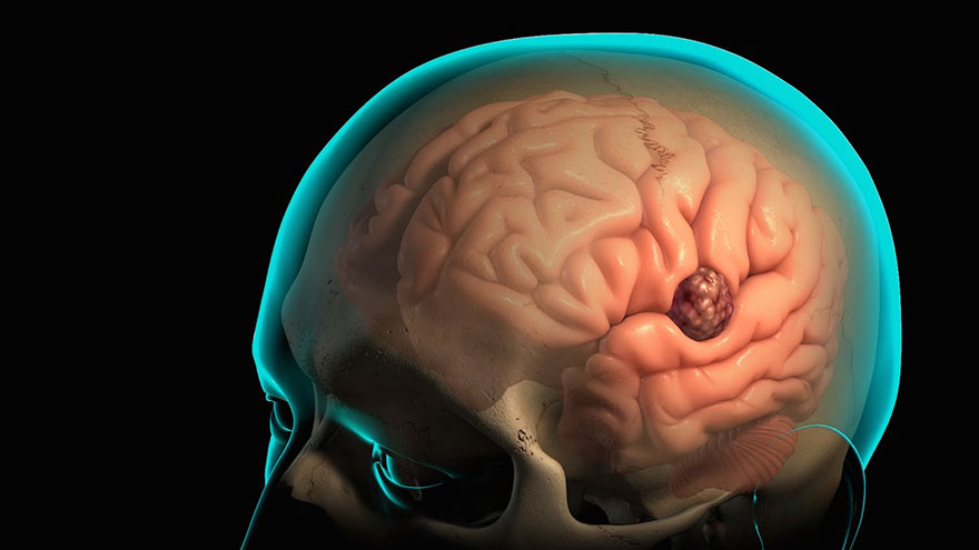 Untreated Glioblastoma